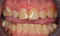 jresizedBefore-teeth---Copy.jpg